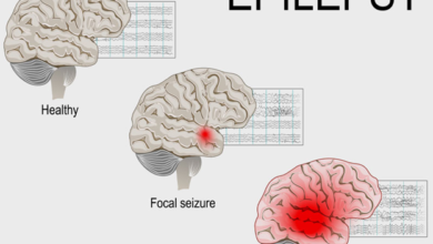 Top Epilepsy Treatment Methods: Medications Surgery & Lifestyle Changes