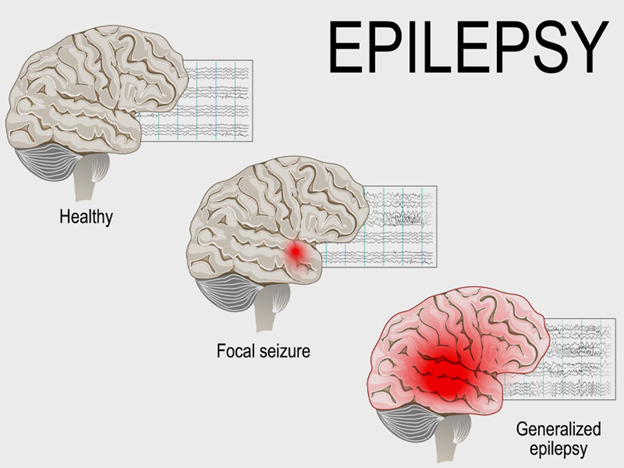 Top Epilepsy Treatment Methods: Medications Surgery & Lifestyle Changes